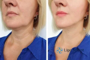 Double chin before and after Hi-Fu treatment 4 Book your double chin treatment Beaconsfield today! We are here to help!