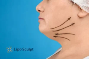 Double chin before and after Hi-Fu treatment 3 Boost your confidence with a Double chin treatment Beaconsfield