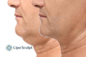 Double chin before and after Hi-Fu treatment 2 Double chin treatment Beaconsfield from Lipo Sculpt - feel more confident today!