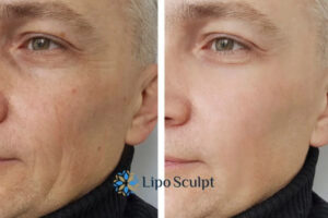 How to Fight Aging Symptoms 3 Fight Aging Symptoms Beaconsfield With HIFU and Morpheus8 Today!