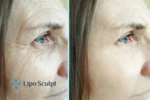 How to Fight Aging Symptoms 2 Do you want to Fight Aging Symptoms Beaconsfield? Contact Lipo Sculpt today!