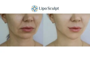 Explaining Total Skin Tightening Treatment And What It Can Do For You 2 Do you want to boost your self confidence? Give Morpheus8 Beaconsfield a try today!