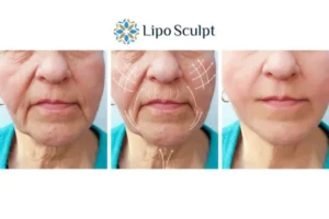 Explaining Total Skin Tightening Treatment And What It Can Do For You 3 Boost your confidence with Morpheus8 Beaconsfield call our team today!