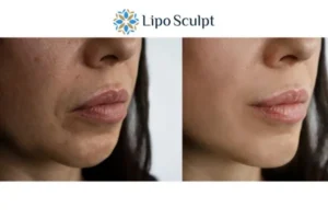 Explaining Total Skin Tightening Treatment And What It Can Do For You 4 Morpheus8 Beaconsfield the best results - call our team today!