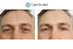 Explaining Total Skin Tightening Treatment And What It Can Do For You 6 Morpheus8 Beaconsfield book in today to find out more!