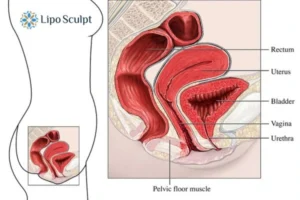 Treatment For A Leaky Bladder 2 How EM Chair treatment Beaconsfield can help Leaky bladder issues. Read more now!