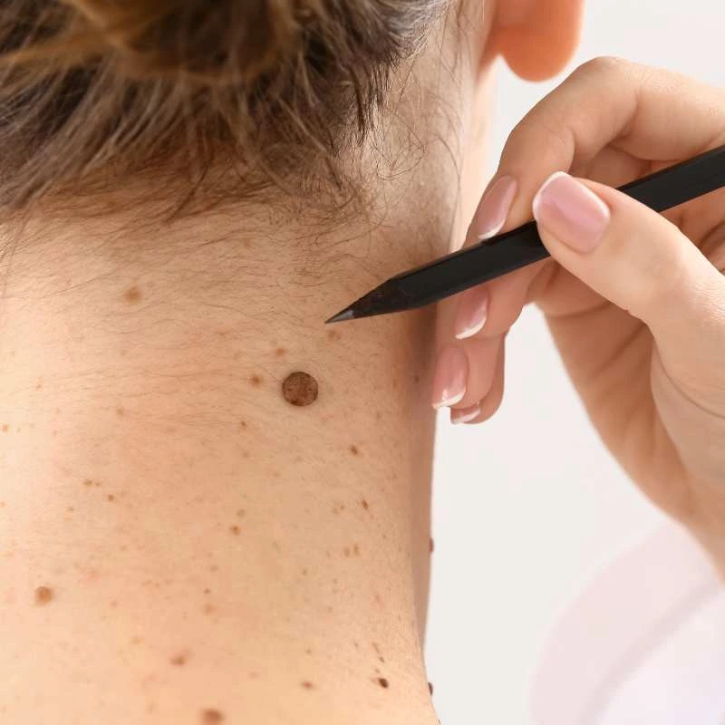 See our lesion removal prices Beaconsfield - call today for a free quote