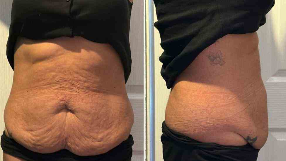 Lost the Weight but Not the Loose Skin? What You Should Know 1 Is It Definitely Loose Skin Beaconsfield?