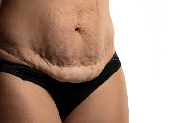 Lost the Weight but Not the Loose Skin? 1 image of womans stomach after weight loss showing loose skin Beaconsfield